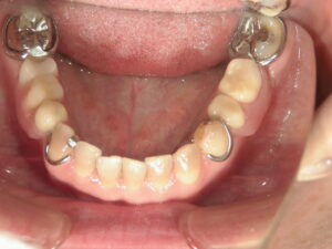 治療前下顎義歯