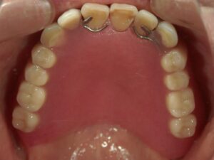 治療前上顎義歯