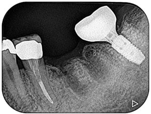 治療2抜歯後レントゲン