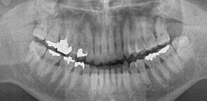 歯周病治療前レントゲン