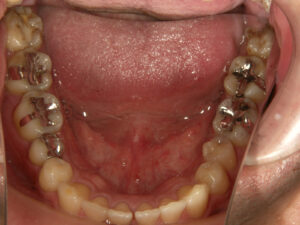 歯周病治療前下顎