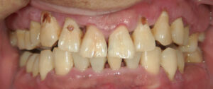 歯周病治療前正面