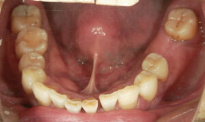 歯周病治療前下顎
