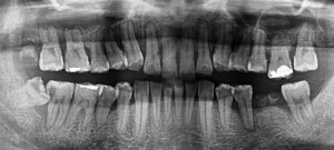 歯周病治療前レントゲン