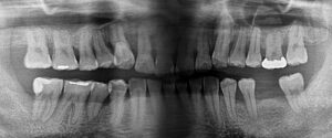 歯周病治療1後レントゲン