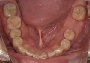 歯周病治療2年後下顎