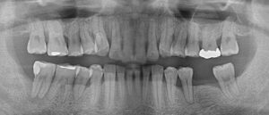 歯周病治療2年後レントゲン