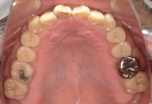 歯周病治療2年後上顎