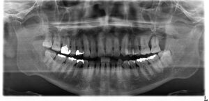 歯周病治療6年後XP