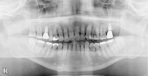 歯周病治療12年後XP