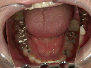 治療前歯像下