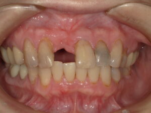 治療後正面義歯なし