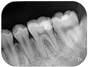 36根管治療術前XRAY