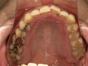 歯周病治療前上顎