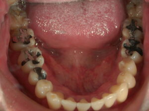 歯周病治療6年後L