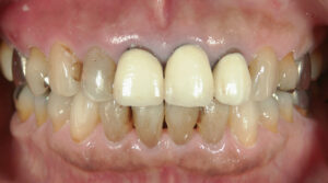 人工歯と歯の色調の不一致