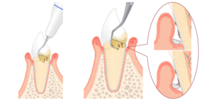 歯周病治療