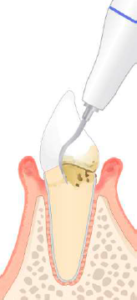 歯周病治療