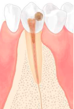 根管治療シェーマ2a