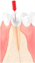 根管治療シェーマ2c