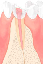 根管治療シェーマ2d