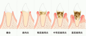 歯周病の進行