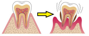 歯周病