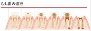 虫歯の進行