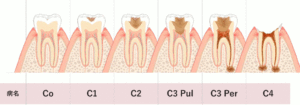 虫歯の進行