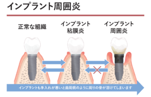 インプラント周囲炎